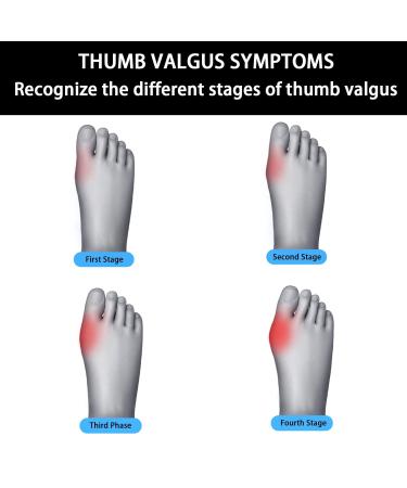 Orthopedic Toe Bunion Corrector Set Adjustable Day/Night Support for Pain Relief and Toe Alignment - Buy Online on GoSupps.com