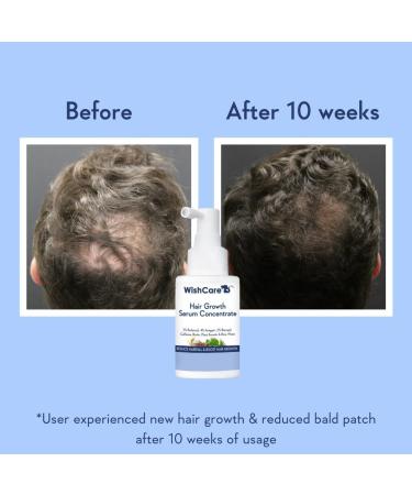 WishCare Hair Growth Serum Concentrate - 3% Redensyl 4% Anagain 2% Baicapil Caffeine Biotin Plant Keratin & Rice Water - Hair Growth Serum for Men & Women 30ml - Buy Online on GoSupps.com