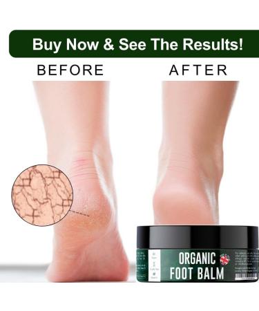 Organic Foot Cream for Cracked Heels & Dry Skin - Antifungal Treatment with Tea Tree Oil & Shea Butter - 200g by NatriGlo - Buy Online on GoSupps.com