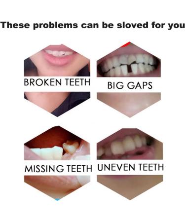 Fake Tooth Repair Kits for Filling The Missing Broken Tooth and Gaps-Moldable Fake Teeth and Thermal Beads Replacement Kits - Buy Online on GoSupps.com