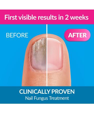 Excilor Nail Fungus Treatment 3.3ml - Fungal Nail Repair for Fingernails and Toenails - Buy Online on GoSupps.com