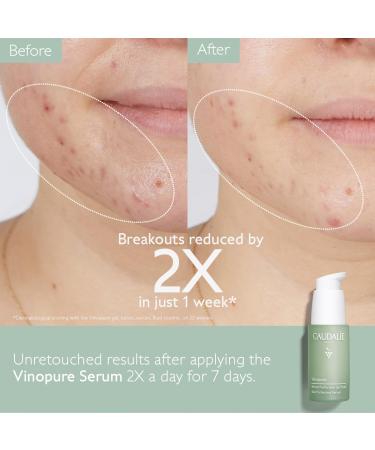 Caudalie Acne-Prone Skin Essentials Set | Salicylic Acid Serum & Free Spot Solution - Best for Clear Skin - Buy Online on GoSupps.com
