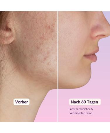 TOTES SEA Mask 250g | Vegan Anti-Acne Dead Sea Mud Mask for Men & Women | Natural Facial Mask for Clear Skin | Clay & Avocado | Best for Pimples & Blackheads - Buy Online on GoSupps.com