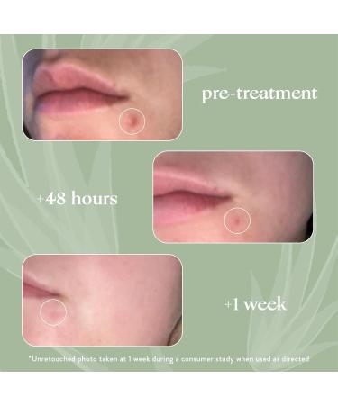 Honest Beauty Acne Spot Treatment for Oily Skin | Salicylic Acid & Glycolic Acid | Vegan Cruelty-Free | 0.5 fl oz - Buy Online on GoSupps.com