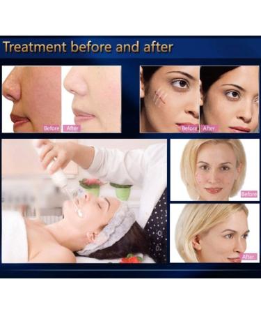 ZJchao HF Stab 5-in-1 High Frequency Acne & Hair Loss Device | Portable Facial & Body Treatment - Buy Online on GoSupps.com