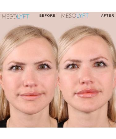 Lip Plumper with Roller to Instantly Plump Lips Promotes Hydration and Fullness Plumping Lip Gloss for Fuller Lips Serum to Moisturize Your Lips (12 ML) 12 Fl Oz (Pack of 1) - Buy Online on GoSupps.com