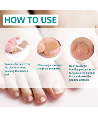 Ingrown Toenail Correction Stickers - Professional Elastic Patch for Curved Toenails - 50PCS - Buy Online on GoSupps.com