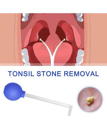 Tonsil Stone Remover Tool - Effective Almond Stones Caster Glass for Oral Hygiene | Mandelsaugers Tonsillenstein Remover for Mouth Cleaning - Buy Online on GoSupps.com