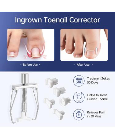 Ingrown Toenail Treatment Kit with 12 Podiatry Braces | Corrector Tool & 50pcs Patch | 10 Strips | White - Buy Online on GoSupps.com