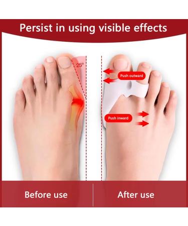 Vinmooog Hallux Valgus Toe Spreader - Silicone Bale Toe Corrector for Pain Relief & Toe Separation - Buy Online on GoSupps.com