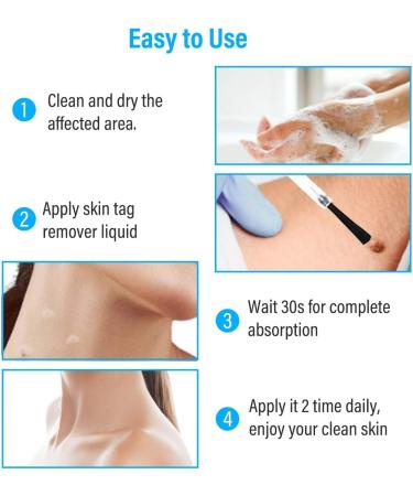 Zacurate Skin Tag Remover & Wart Mole Verruca Treatment Lotion - Fast-Acting Blue Formula - 30ML (Pack of 1) - Buy Online on GoSupps.com