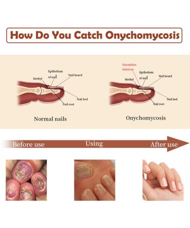 Nail Growth and Strengthening Serum 20ml Nails Repair Serum Fungal Nail Treatment for Toenail Extra Strong Toenail Growth Treatment for Repairing Damaged and Discolored Nails Improve Onychomycosis - Buy Online on GoSupps.com