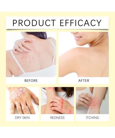 Bee Venom Cream - Bee Venom Wart and Tag Remover - Bee Venom Psoriasis Cream for Soothing - Fast-Acting Relief Psoriasis Treatment Cream - Deep Nourishment & Skin Protection - Buy Online on GoSupps.com