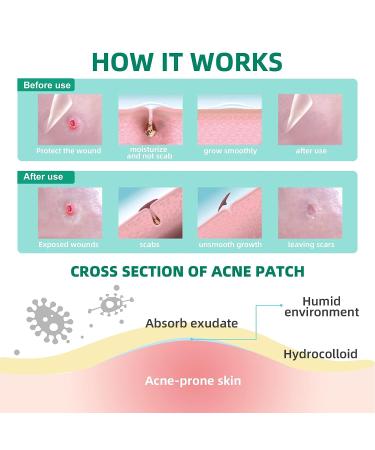 Acotye Pimple Patches 210PCS with Tea Tree Oil, Salicylic Acid & Niacinamide - Blemish Spot Relief - Invisible Patch in 4 Sizes - 8mm, 10mm, 12mm, 14mm - Buy Online on GoSupps.com