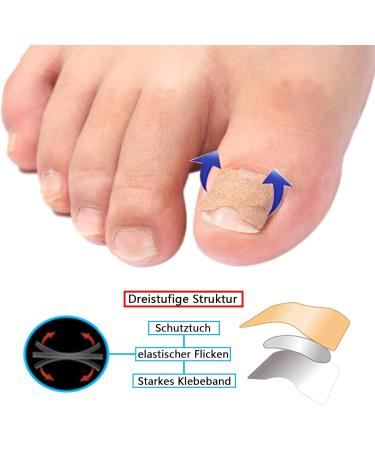 Ingrown Toenail Set 93 Pieces Professional Nail Care Set Correction Sticker Paronychia Corrector Toenail File and Lifter Toenail Patch for Men Women Toenail Care - Buy Online on GoSupps.com