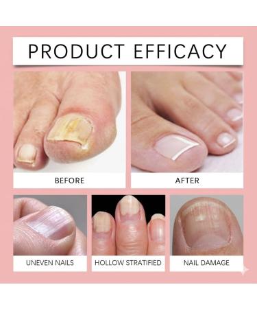  HNYXEQJL Set of 5 nail hardening gels for stronger nails multi-effect nail care serum deep conditioning strengthens makes nails flexible quick-drying gentle nail care for sensitive skin - Buy Online on GoSupps.com
