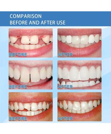 BrightView Temporary Teeth - Instant Veneers & Thermal Adhesive Beads for Missing Tooth Repair (30g) | International Shipping Available - Buy Online on GoSupps.com