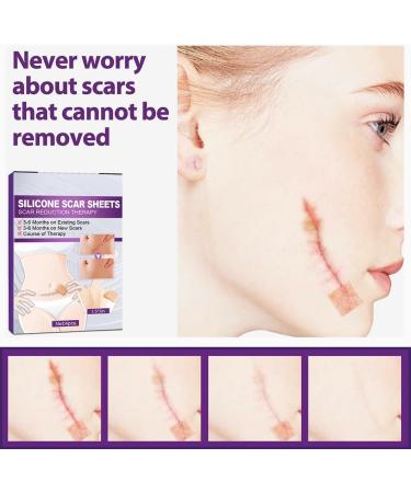 Silicone Scar Removal Sheets 4pcs/Box - Reusable Surgical Scar Sticker for Trauma Burn Scars - Acne Repair Treatment Patches - 4 * 7.5cm - Color 5pcs - Buy Online on GoSupps.com