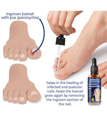 German ToenailPlus Anti Paronychia Relief Oil - Repair Damaged Nails (2 Pcs) - Buy Online on GoSupps.com