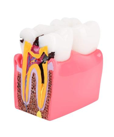 High-Quality Dental Prosthesis Model for Oral Care | International Shipping Available - Buy Online on GoSupps.com