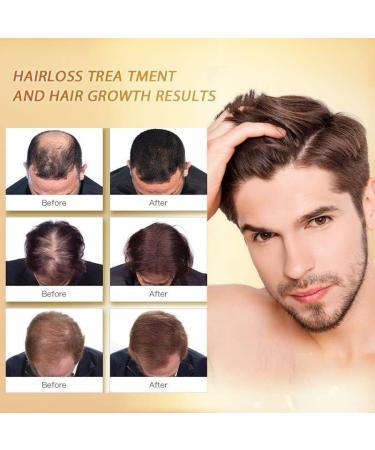 GFOUK Scalp Folliculitis Treatment Scalp Treatment Hair Oil Nourishing Treatment for Split Ends and Dry Scalp for All Hair Types - Buy Online on GoSupps.com