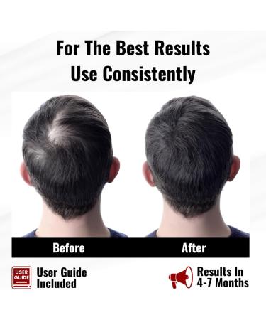 HOMESTA Red light therapy hair cap. Laser hair growth Hair regrowth treatment for men Led hair growth Red light hair therapy Red light therapy hair growth Red light hair growth - Buy Online on GoSupps.com