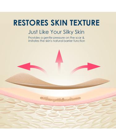 Krucasano Advanced Silicone Scar Sheets - 4 Reusable Sheets for Surgery, C-Section, Burn, Keloid, Acne, Old & New Scars - Hypertrophic Scar Removal - Buy Online on GoSupps.com