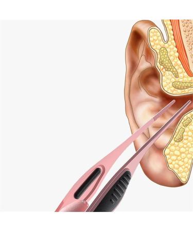 HNKDD Stainless Steel Luminous Ear Tweezers - Children's Ear Cleaner with Gray Ear Pick - Ear Digging and Wax Removal Tool - Buy Online on GoSupps.com