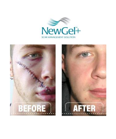 NewGel+E Advanced Silicone Scar Treatment Gel with Vitamin E - For Old and New Scars, Surgery, Injury, Keloids, Burns, and Acne Scars (1 oz) - Buy Online on GoSupps.com