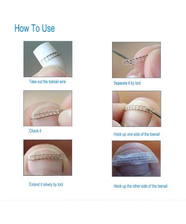 Ingrown Toe Wire Fixer 12Pcs/Box Stainless Steel Toenail Correction pedicure Tool with 6 Sizes for Nail Recover Foot Care Bunion Corrector - Buy Online on GoSupps.com