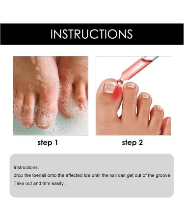 Ingrown Toenail Treatment Fungal Nail Treatment Ingrown Toenail Drops Nail Care and Treatment Strengthen Renew Damaged Nail(30ML) - Buy Online on GoSupps.com