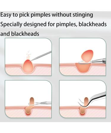 Usiveinborn Blackhead Remover Usiveinborn Usiveinborns Usiveinborn Tweezers Professional Facial Blackhead Remover Tweezers Stainless Steel Usiveinborn Blackhead Tweezers (8PCS) - Buy Online on GoSupps.com