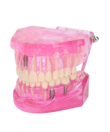 Transparent Adult Teeth Model - Pathological Removable Dental Teaching Tool Standard Size - Ideal for Study & Repairs - Buy Online on GoSupps.com