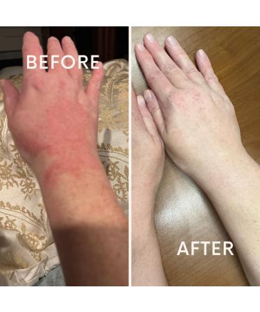 EczemaGuard Hand Eczema Cream - Natural Relief for Kids & Adults | Hypoallergenic Moisturizer for Sensitive Skin | 6oz Itchy Skin Calming Cream - Buy Online on GoSupps.com