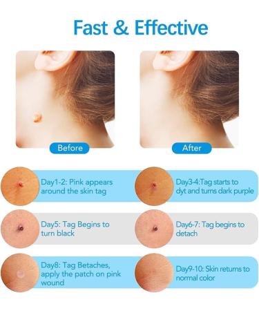 2-IN-1 Skin Tag Tool Kit for Men and Women Fast and Easy Micro Skin Tags Skin Tag Tool Kit Painless Skin Tag Kit for Small (2mm) to Medium (8.5mm) Skin Tags - Safe for Most Parts - Blue - Buy Online on GoSupps.com