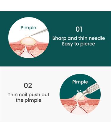 Acne Needle Blackhead Remover Acne Removal Needle Professional Pimple Spot Popper Tools Zit Extractor Face Skin Care Beauty Facial (Color : Mr-2178) - Buy Online on GoSupps.com