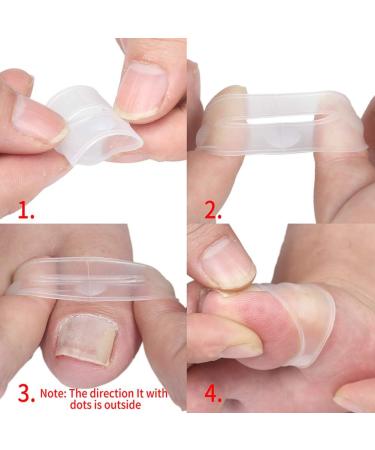 Ingrown Toenail Corrector Pain Relief Treatment Tool Made of Silicone Transparent Simple and Effective - Buy Online on GoSupps.com