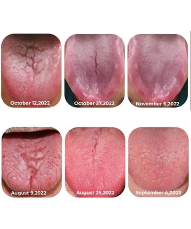 2PC Canada Polumna Fissured Tongue Relief Spray | Best 2023 Treatment & Breath Freshener for Women | Boost Oral Health - Buy Online on GoSupps.com