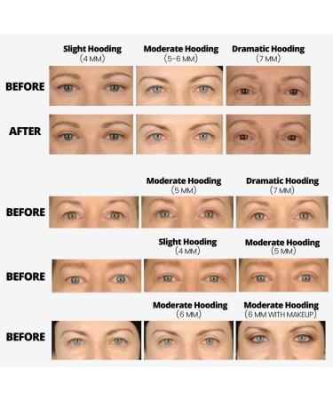 LIDS BY DESIGN Assortment Pack (4mm - 7mm) Eyelid Correcting Strips - Lift Heavy Hooded Droopy Lids - Buy Online on GoSupps.com