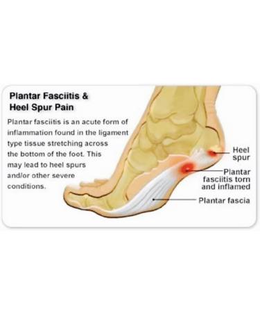 Plantar Fasciitis Compression Sleeve - Small/Medium | International Shipping Available - Buy Online on GoSupps.com