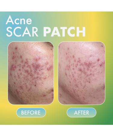 Fazit Acne Scar Treatment Patches - 24 Individual Patches for Face Bikini & Body - Effective Acne Scar Remover - Buy Online on GoSupps.com