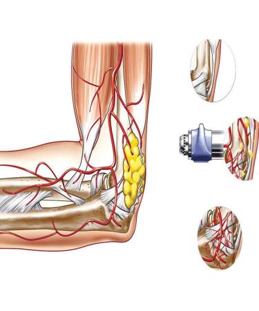 Acoustic Shockwave Therapy Device for Pain Relief - ED Shockwave Machine for Back, Waist, Leg Pain - Blue2 - Buy Online on GoSupps.com