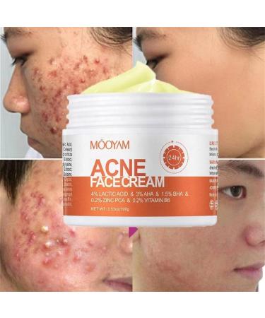 Acne Spot Treatment Cream for Acne 100g AHA BHA Lactic Acid & Zinc Scar Pimple Cream for Face Anti-Blemish Care  - Buy Online on GoSupps.com