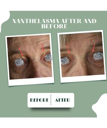 XanthRemover 70% Glycolic Acid Peel Gel | Improve Xanthelasma, Brown Spots, Dark Spots | Upper Eyelid Tightening | Anti-Aging Treatment - Buy Online on GoSupps.com