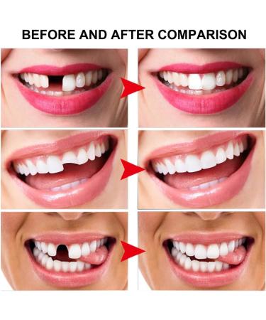 Tooth Repair Kits - Moldable Fake Teeth & Temporary Fix Beads | Dental Probe & Mirror Included - Buy Online on GoSupps.com