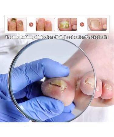 Fungus Treatment Oil Foot Fungus Oil Kerasentials Nail Treatment Healthy Natural Repair Nails Natural Toenail for Damaged & Discolored Toe Nails (2pcs) - Buy Online on GoSupps.com