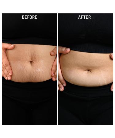 Stretch Mark & Scar Fading Oil | Natural Almond Rosemary & Rosehip Oils | Reduce Stretch Marks & Aging Signs for Glowing Skin - 1.5 fl oz - Buy Online on GoSupps.com