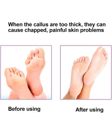 Electric Foot Files Callus Remover For Callus Remover For Feet Rechargeable Foot Grinder For Cracked Feet Electric Foot File Hard For Callus Shavers With Heels And Dead Skin - Buy Online on GoSupps.com