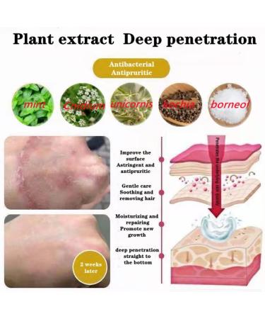 Chinese Herbal Eczema Psoriasis Cream | Anti-Itch Dermatitis Relief | Defeon New Face & Body Cream - 1pcs - Buy Online on GoSupps.com