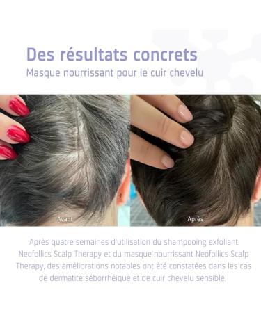 Neofollics Scalp Therapy Noursching Mask - 175 ml - Masque cuir chevelu non gras sans rin age - Nettoie en profondeur et apaise le cuir chevelu - Buy Online on GoSupps.com